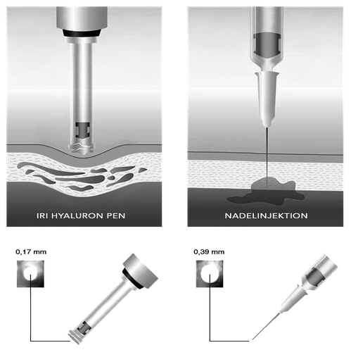 needle-injection-vs-hyaluron-pen